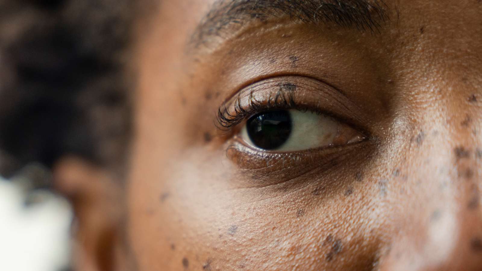 Anesthesia Injection, a New Way to Correct 'Lazy Eye'?